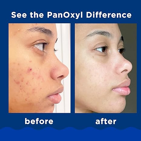 PanOxyl Acne Foaming Wash